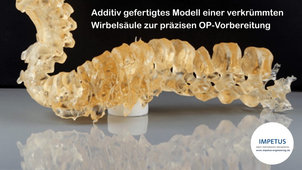 Additiv gefertigtes Modell einer verkrümmten Wirbelsäule zur präzisen OP-Vorbereitung