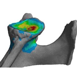 Prozesskette-digital-patientenindividuelle-Schulterimplantate